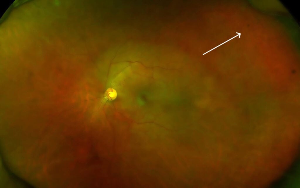 myotonic dystrophy figure 5 edit (1)