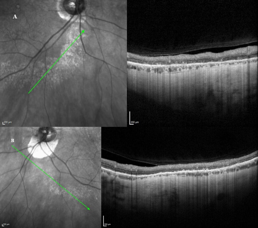 Figure 4. SD-OCT line scan of the right eye (A) and the left eye (B).
