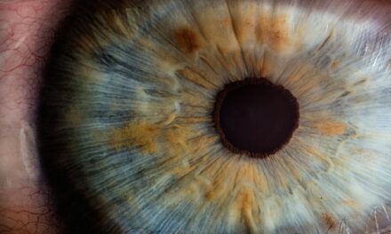 A Rare Case of Recurrence of Bilateral Corneal Edema Secondary to Amantadine