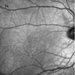 Benign Yellow Dot Maculopathy
