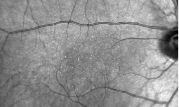 Benign Yellow Dot Maculopathy