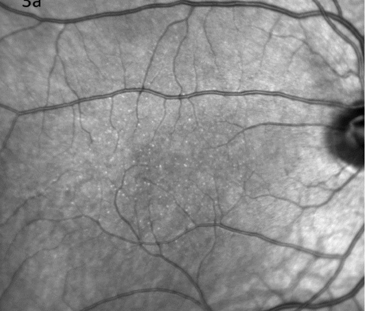 Benign Yellow Dot Maculopathy