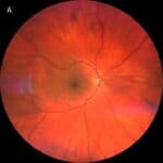 Behcet’s Disease Flares Up BADS: A Bilateral Anterior Diffuse Scleritis Case Report