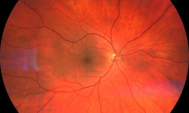 Behcet’s Disease Flares Up BADS: A Bilateral Anterior Diffuse Scleritis Case Report