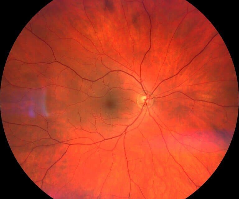 Behcet’s Disease Flares Up BADS: A Bilateral Anterior Diffuse Scleritis Case Report