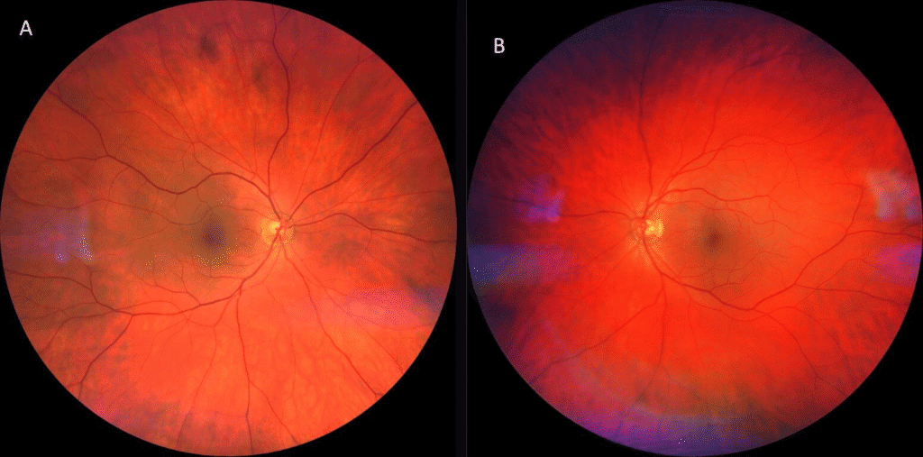 behcets figure 1b (medium)(1) imageonline.co merged