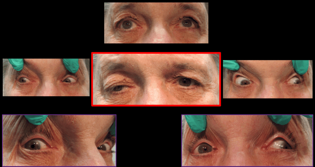 fig 1 eom pattern(1) (medium)