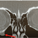 The “Not So Easy” Orbital Floor Fracture Case