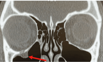 The “Not So Easy” Orbital Floor Fracture Case