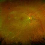 Pseudoxanthoma Elasticum and Angioid Streaks