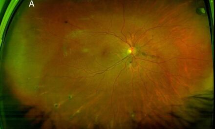 Pseudoxanthoma Elasticum and Angioid Streaks