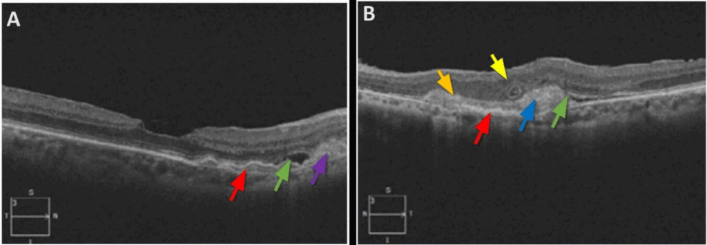 pxe fig 3b (medium) imageonline.co merged