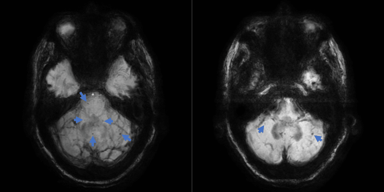 Ocular Tilt Reaction Associated with Infratentorial Microhemorrhages and Siderosis