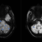 Ocular Tilt Reaction Associated with Infratentorial Microhemorrhages and Siderosis