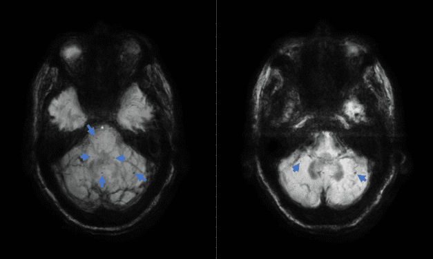 Ocular Tilt Reaction Associated with Infratentorial Microhemorrhages and Siderosis