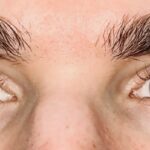 A Case Series of Ophthalmic Manifestations of Facial Botox Injections