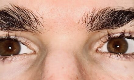 A Case Series of Ophthalmic Manifestations of Facial Botox Injections