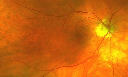 Navigating Choroidal Folds: A Comprehensive Approach for the Primary Care Optometrist