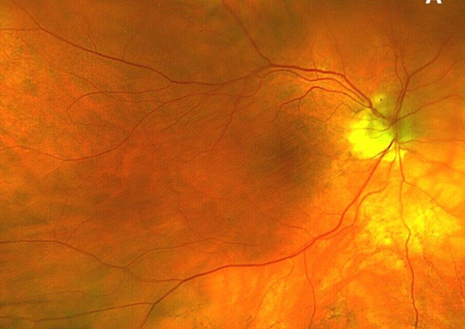 Navigating Choroidal Folds: A Comprehensive Approach for the Primary Care Optometrist