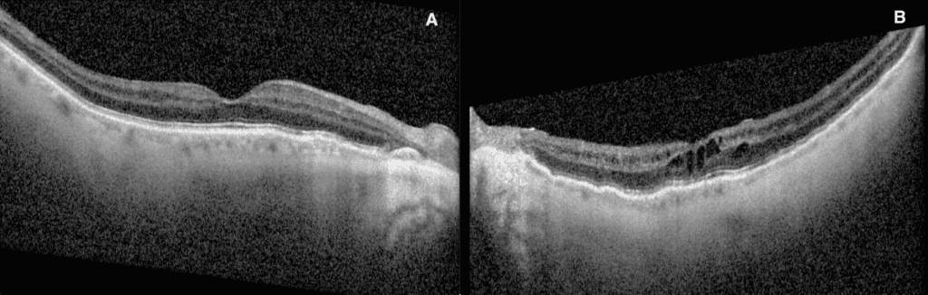 choroidal folds figure 2b imageonline.co merged(1) (medium)