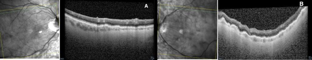 choroidal folds figure 3b imageonline.co merged(1) (medium)