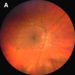Anemic Retinopathy Secondary to Babesiosis Infection