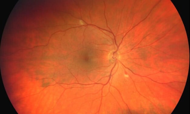 Anemic Retinopathy Secondary to Babesiosis Infection