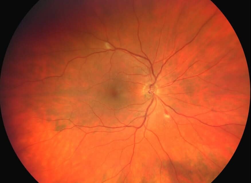 Anemic Retinopathy Secondary to Babesiosis Infection