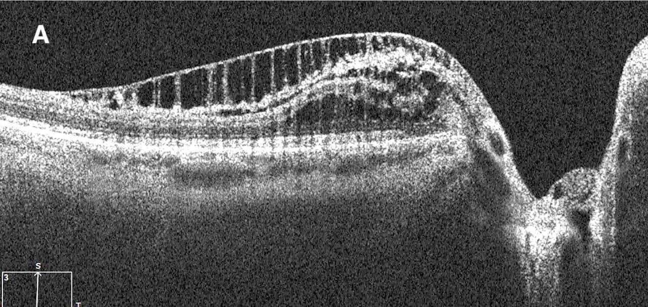 Paradoxical Progression in Nerve Fiber Analysis from Peripapillary Retinoschisis