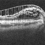 Paradoxical Progression in Nerve Fiber Analysis from Peripapillary Retinoschisis