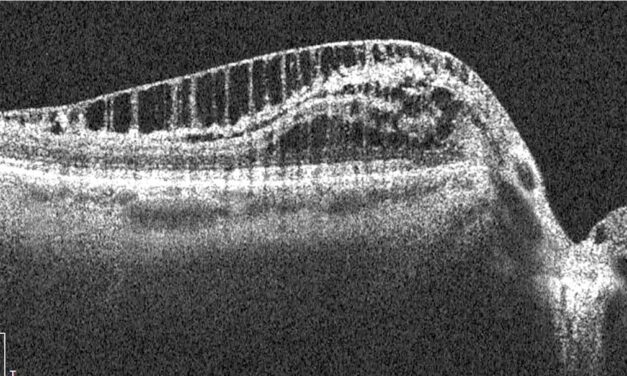 Paradoxical Progression in Nerve Fiber Analysis from Peripapillary Retinoschisis