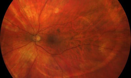 Photo Essay – A Spiral Illusion: An Atypical Presentation of Schlaegel Lines