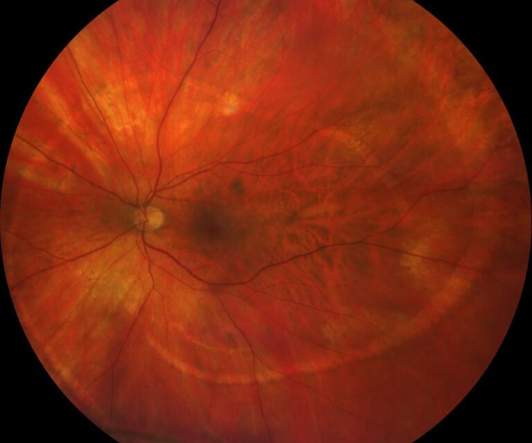 Photo Essay – A Spiral Illusion: An Atypical Presentation of Schlaegel Lines