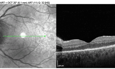 Bilateral Optic Nerve Edema Leading to the Diagnosis of Ocular Syphilis
