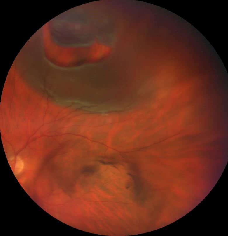 A Brief Report on Rhegmatogenous Retinal Detachment Management and Post-Surgical Retinal Displacement