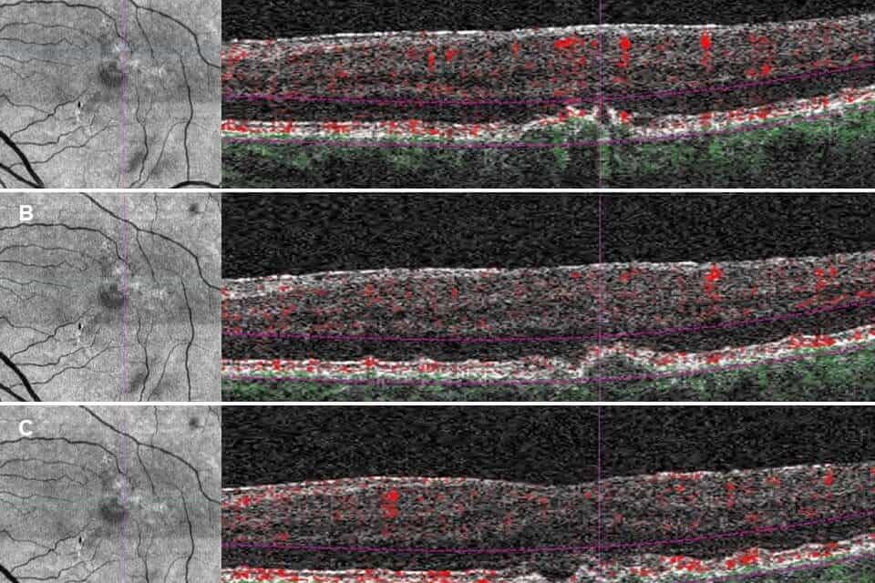 Subjective Dyschromatopsia as presenting symptom of Neovascular Age-Related Macular Degeneration