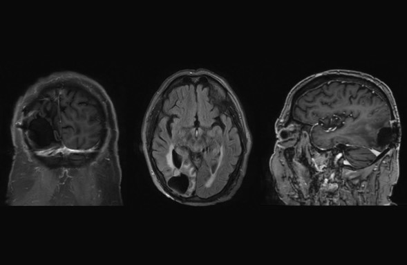 Primary central nervous system diffuse large B-cell lymphoma presenting as homonymous hemianopia