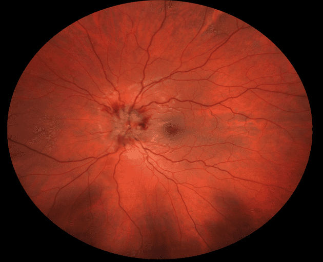 Atypical optic neuritis resulting in a diagnosis of MOGAD