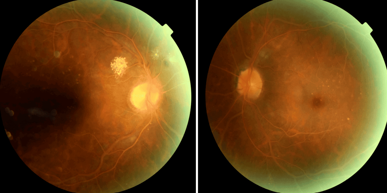 Retinopathy Prompting Laboratory Testing: a report of two cases