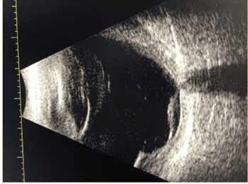 A Diagnostic Challenge of Scleromalacia Perforans