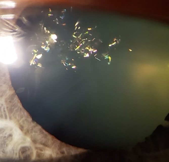 PHOTO ESSAY: Unilateral Christmas Tree Cataract