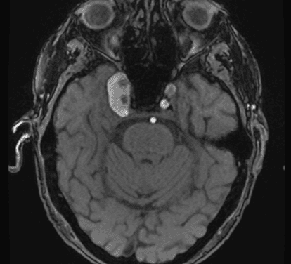 Complications of a Giant Cavernous Carotid Artery Aneurysm