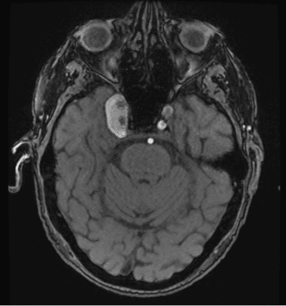 Complications of a Giant Cavernous Carotid Artery Aneurysm