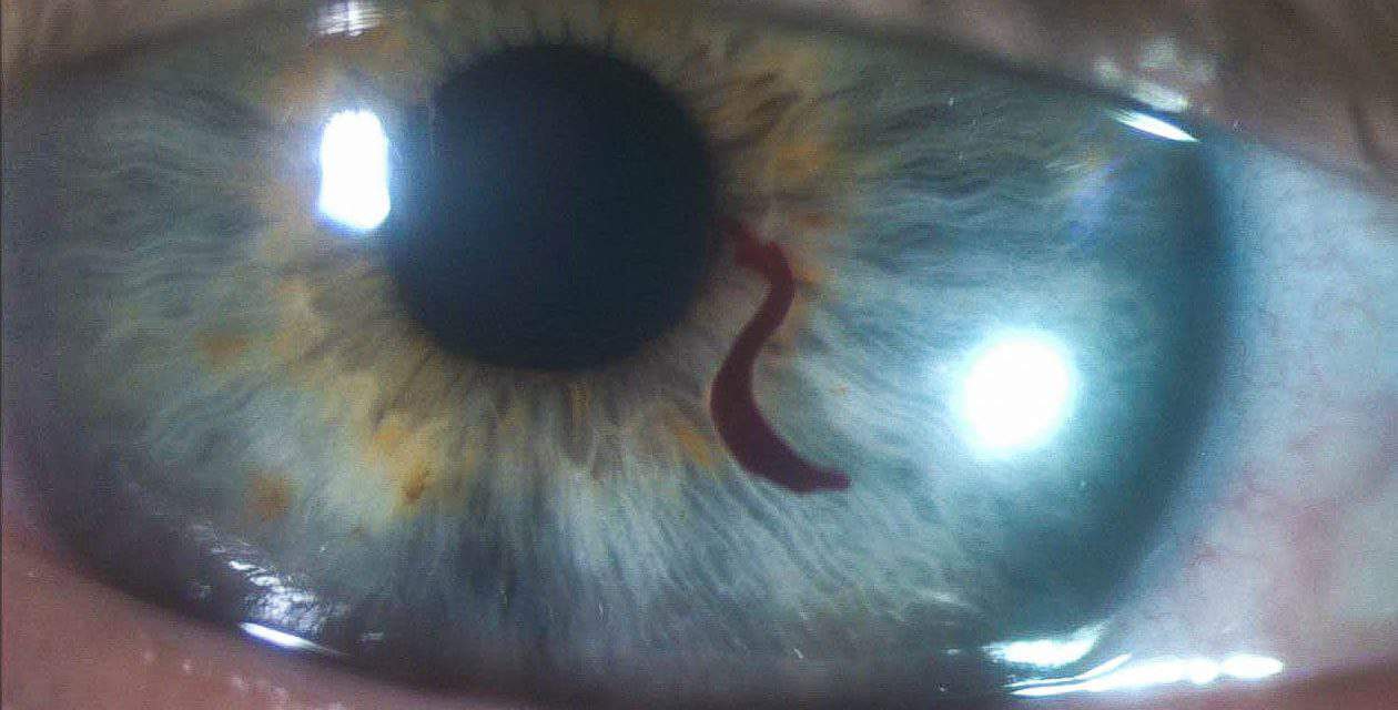 PHOTO ESSAY: Idiopathic Atypical Hyphema