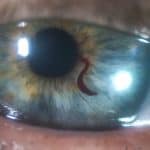 PHOTO ESSAY: Idiopathic Atypical Hyphema
