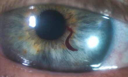 PHOTO ESSAY: Idiopathic Atypical Hyphema