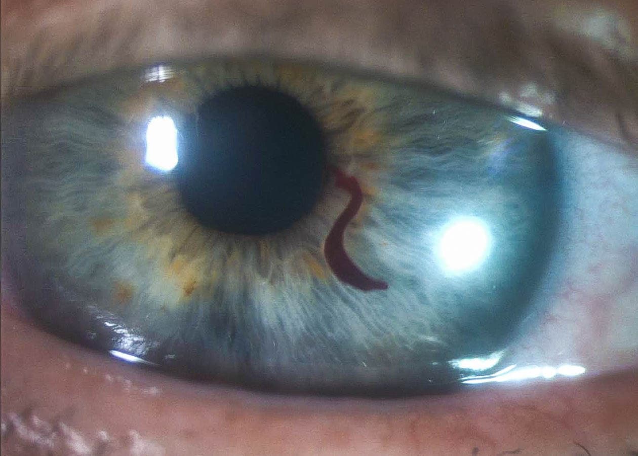 hyphema (1)