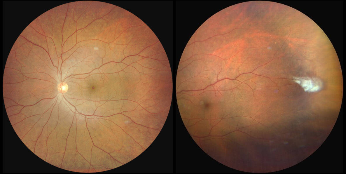 Sickle cell retinopathy: diagnosis, management, and treatment