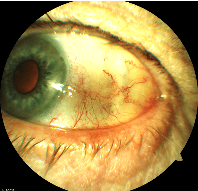 Figure 2. The lesion of the left eye at the temporal bulbar conjunctiva status post treatment with 5-FU for CIN. Â