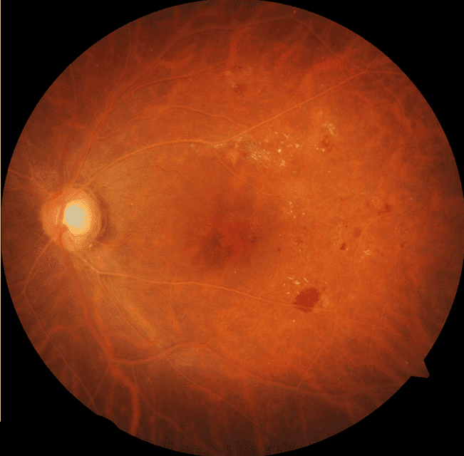 Highlighting hypertriglyceridemia with a case of lipemia retinalis